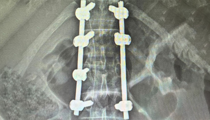 Management of Spine Trauma Fractures