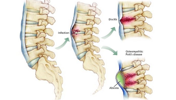Spine Tumors & Infections